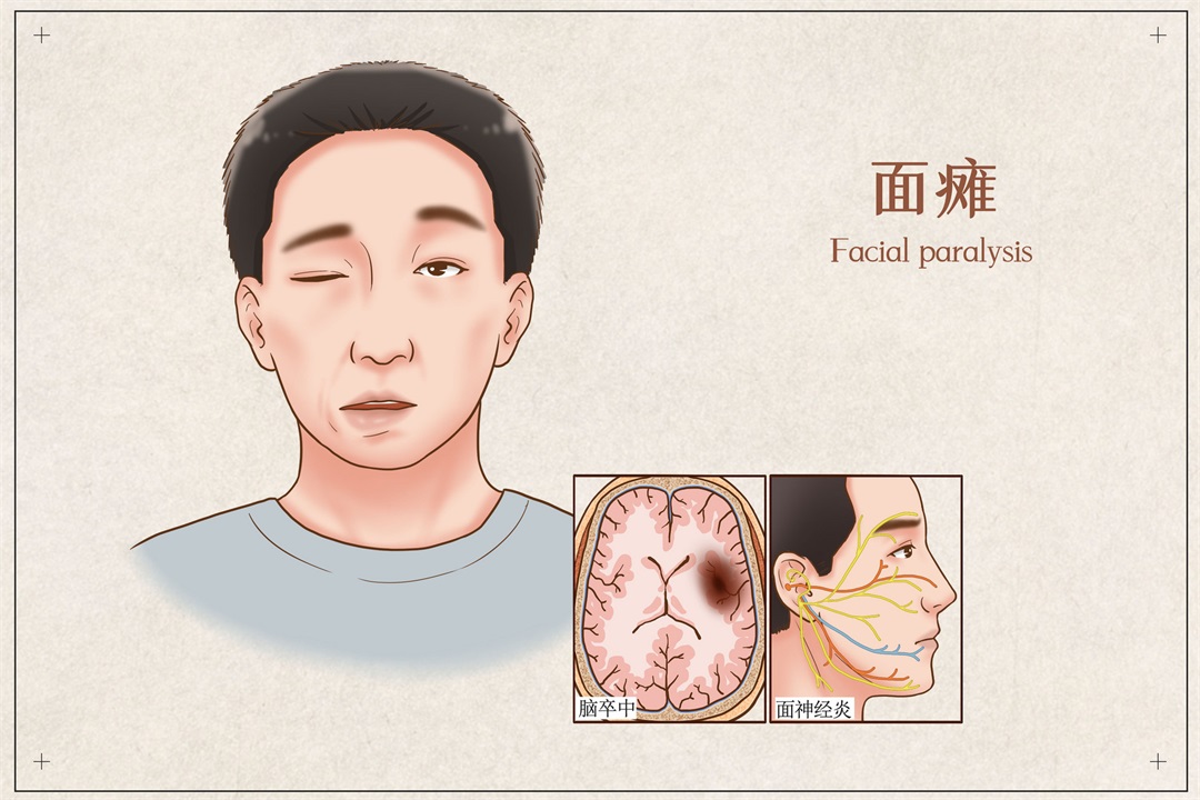 茶葉批發(fā)丨養(yǎng)生茶丨艾條的作用丨艾灸養(yǎng)生
